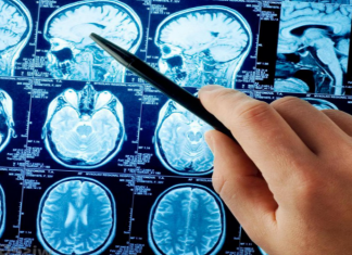 Инсульт головного мозга — прогноз, последствия и профилактика Инсульт головного мозга - одна из опаснейших патологий