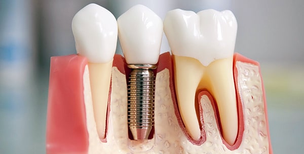 Зубные импланты: в какую клинику в Киеве лучше обратиться?