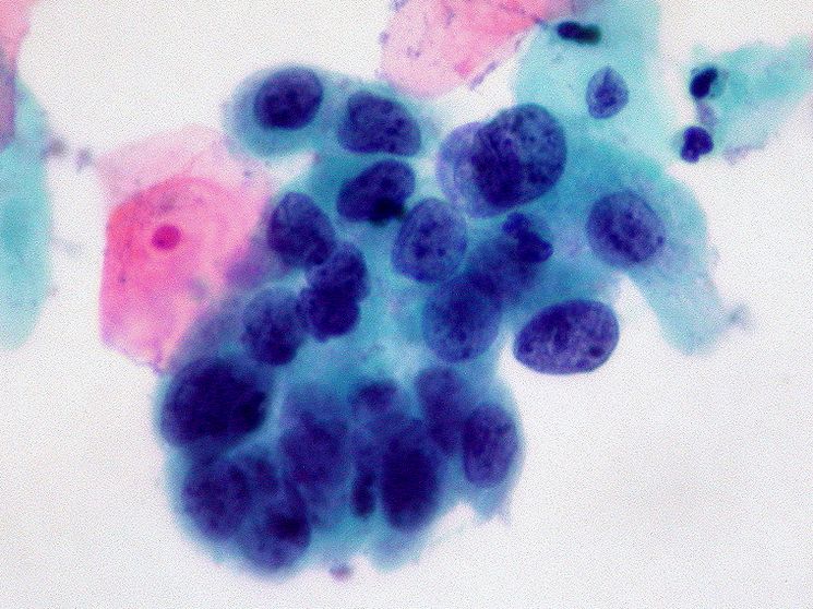 Рак - Опухолевые клетки карциномы 