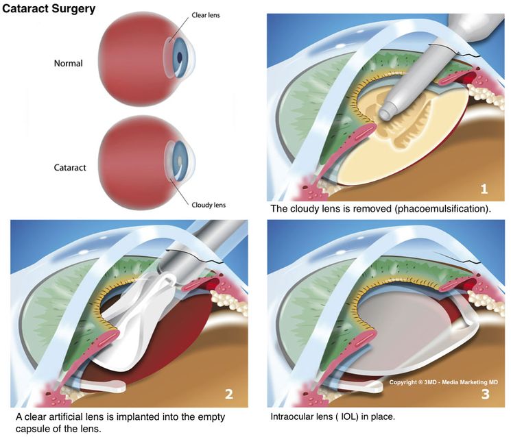 Операция по удалению катаракты глаза