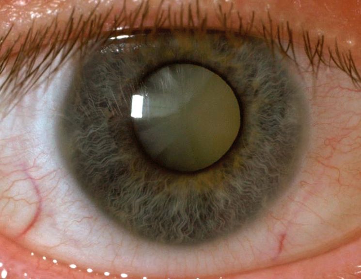 Методы лечения катаракты глаз