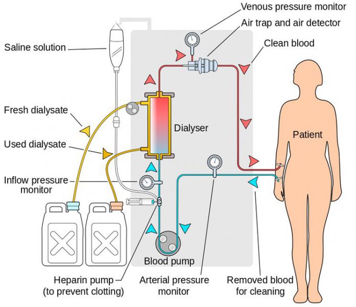Что такое гемодиализ почек