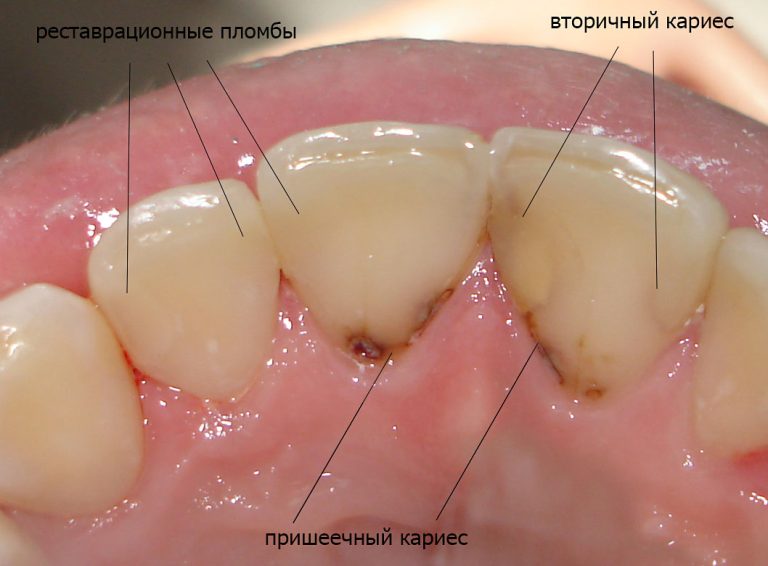 Лечение кариеса: Методы и Процесс