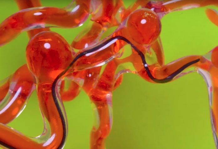 Лечение сосудов головного мозга с помощью робота змеи