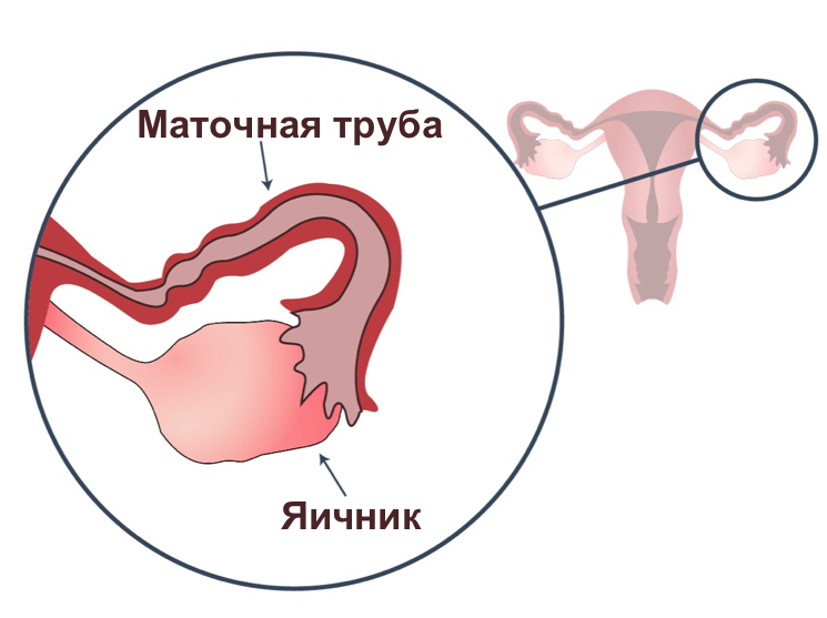 Могут ли сперматазоиды продвигаться по трубам