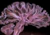 Общий вид головного мозга при микротравлении