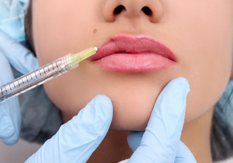 Пример инъекции гиалуроновой кислоты в губы
