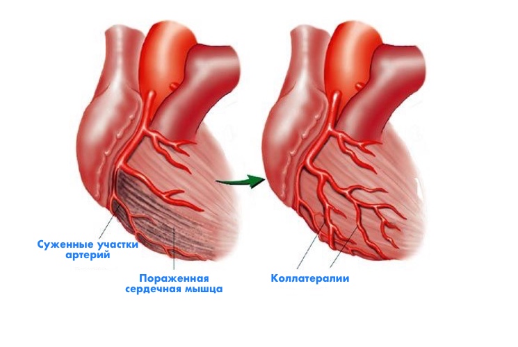 Процедура возникновения коллатералей