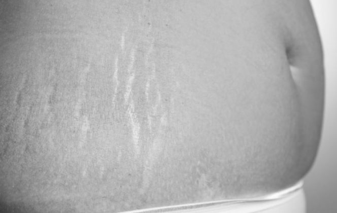 Стрии / растяжки на теле - как избавиться от атрофии кожи? - Science Debate