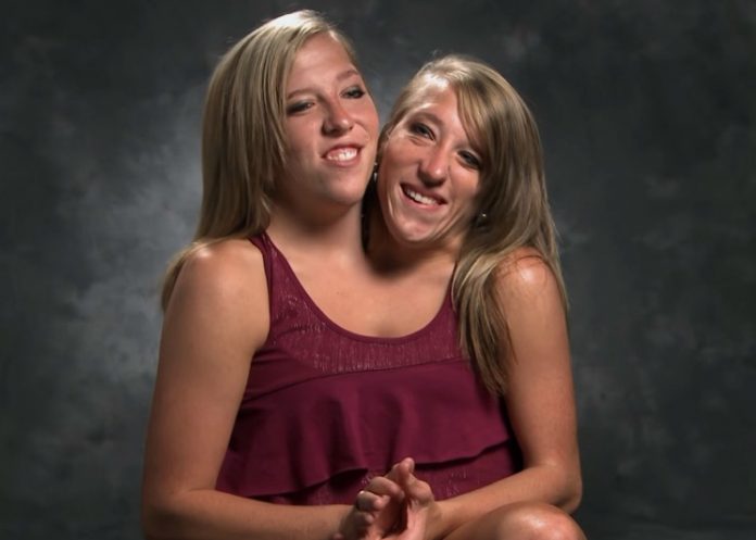 Сиамские близнецы Эбби и Бриттани