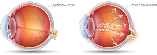 Как лечить глаукому Как лечить глаукому