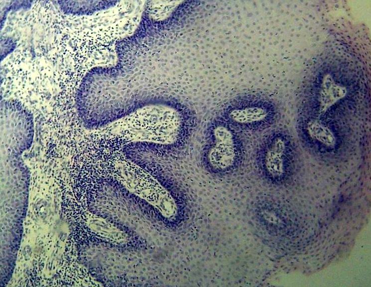 Гистологическое исследование вируса папилломы человека на коже